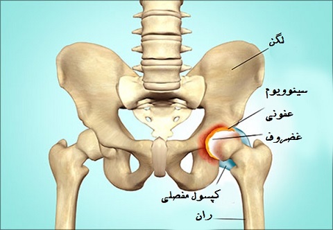 علل دررفتگی مفصل لگن